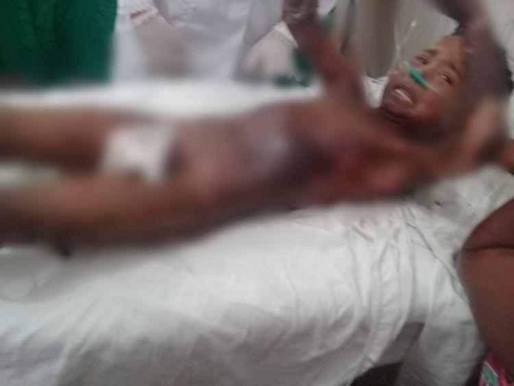 SECRETÁRIO DE ESTADO DA SAÚDE DO MARANHÃO CARLOS LULA, EMITE NOTA SOBRE O CASO DA CRIANÇA QUEIMADA EM CARVOEIRA NO INTERIOR DO ESTADO